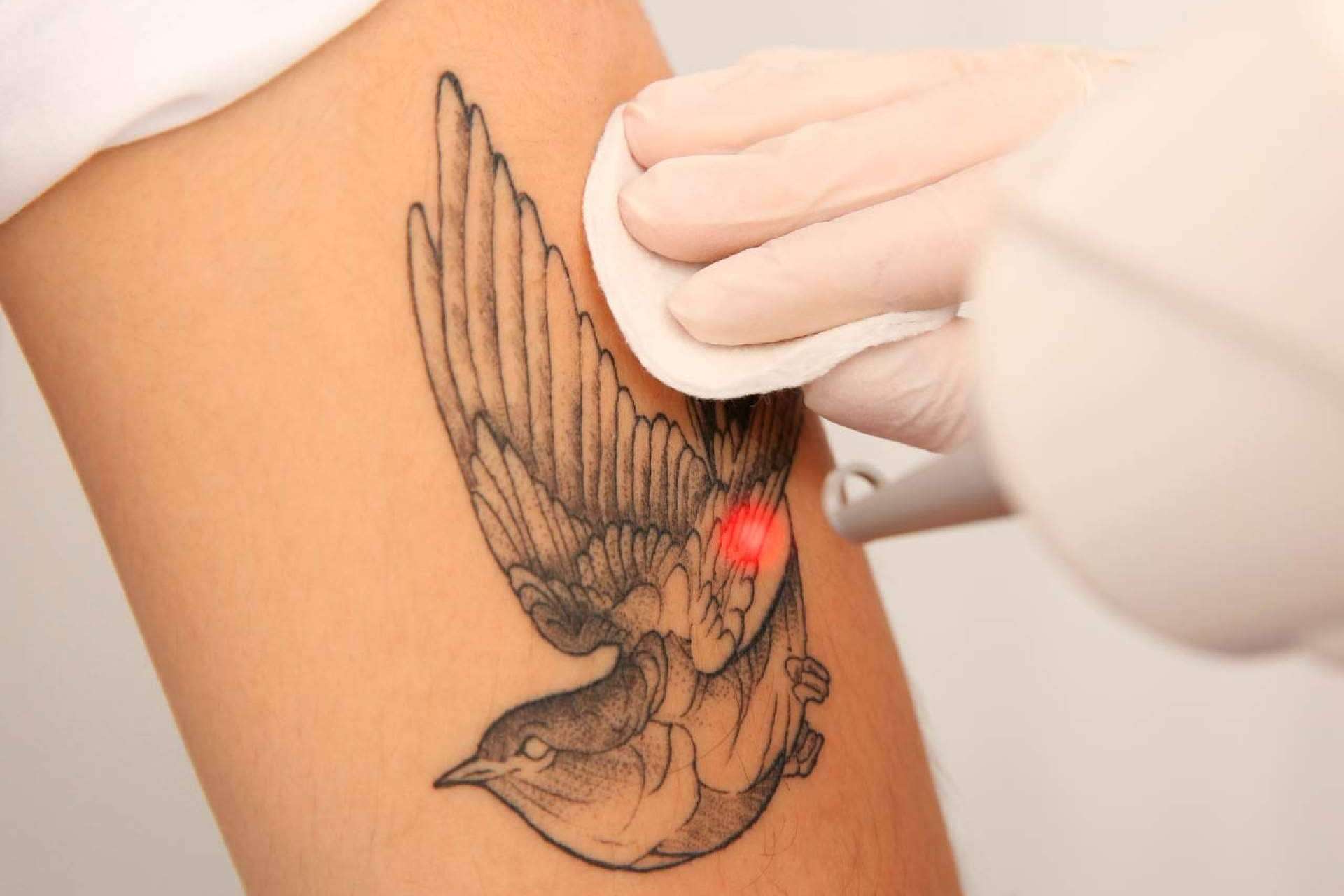Despigmentación de tatuajes sin dañar la piel, el tratamiento con picolaser en 360Clinics