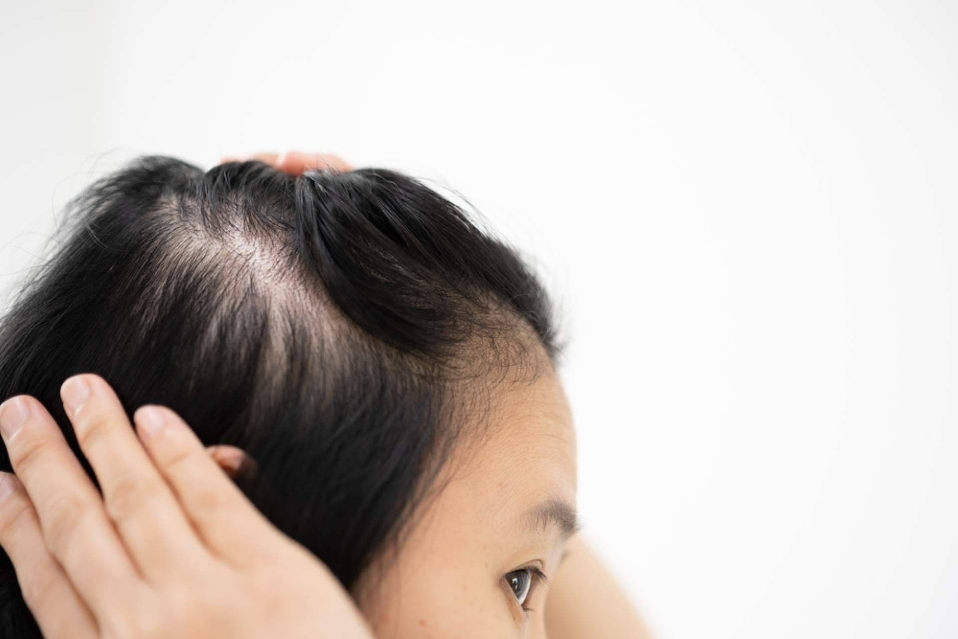 Estrés y caída de cabello ¿están relacionados?